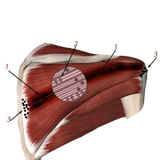 Комплекс триггерных точек в мышце плеча